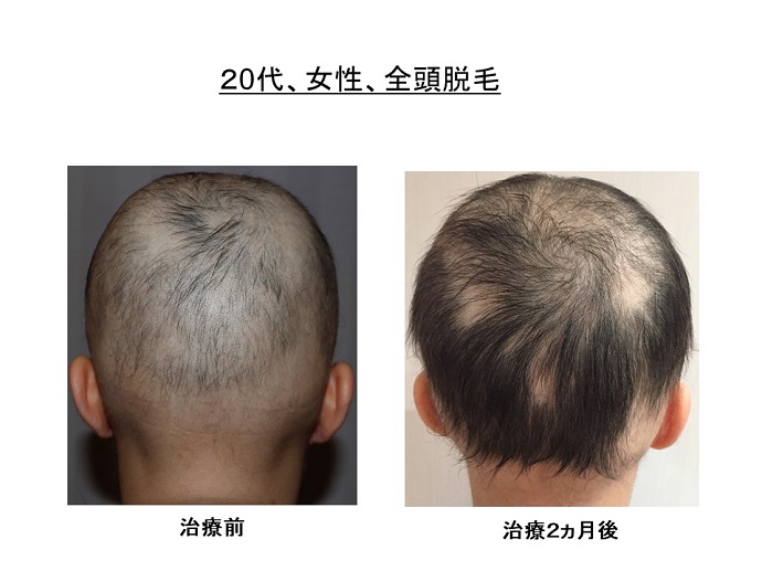 円形脱毛症　病院